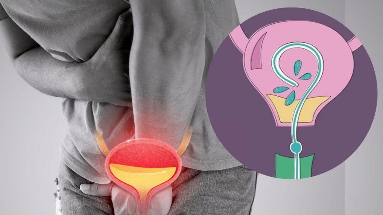 মূত্রথলির ক্যানসার: কারণ, লক্ষণ, চিকিৎসা ও প্রতিরোধে করণীয়